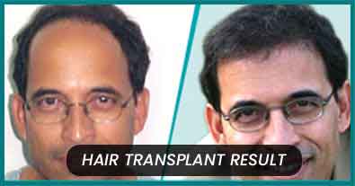 Hair Transplant in Allahabad  Hair Transplant Clinic  Cost