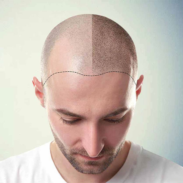 Hair Transplant in Delhi