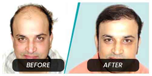 celebrity hair transplant clinic