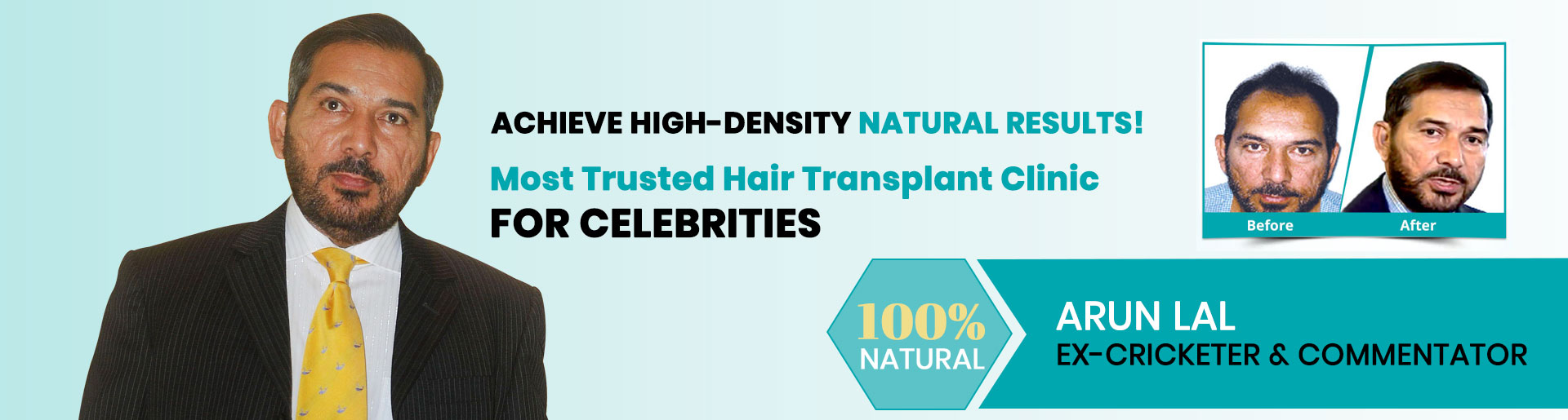 Hair Transplant Result of Arun Lal - Ex Cricketer