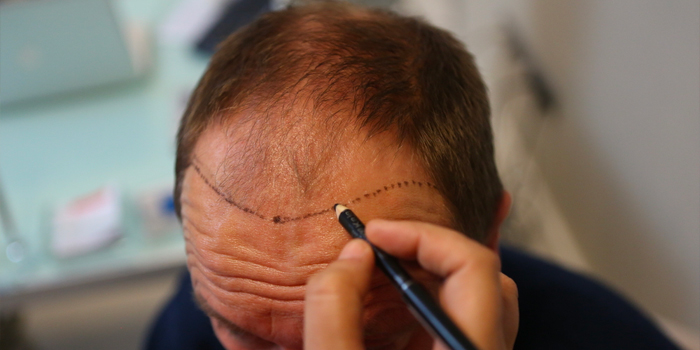 Different Types Of Hair Transplantation Techniques