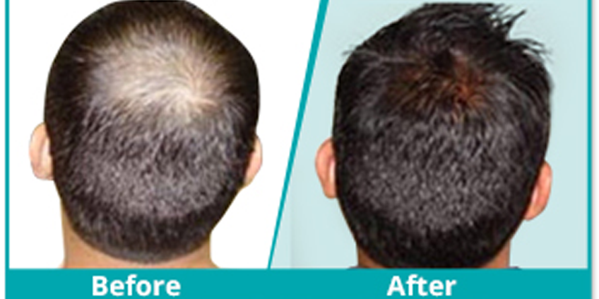 What Makes The Best Hair Transplant Surgeon?