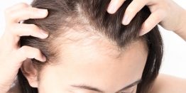 5 Reasons For Hair Loss in Women Be More Considerate Next Time