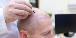 How Much Does A Hair Transplant Cost In India