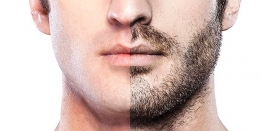 The Growing Popularity Of Beard Transplant Among Young Men