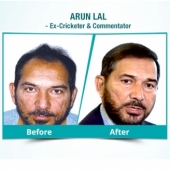What does the hair transplant surgery cost in Delhi?