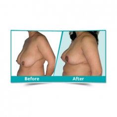 Breast Reduction lift Surgery in Delhi 