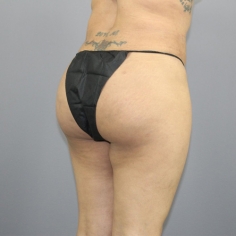 Buttock liposuction in Delhi 