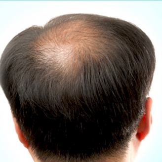 Causes of Hair Loss in Men, Women, Teenage 