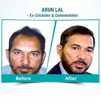 Arun Lal Hair Transplant
