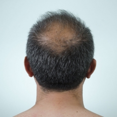 Male Hair Loss Treatment in Delhi 