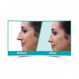 Nose Reshaping Surgery in Delhi 