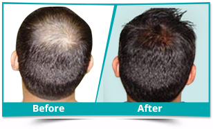 Result of Hair Loss Treatment
