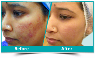Delhi - Dermatology Result