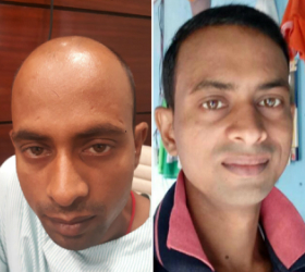 hair treatment clinic in delhi