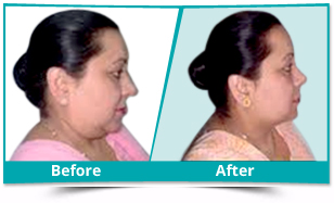 Delhi - Chin Surgery Result