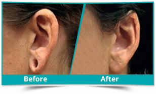 Delhi - Ear Lobe Repair Result