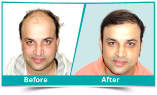 Delhi - FUE Hair Transplant Result