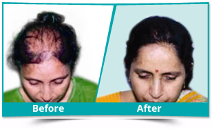 Best Hair Transplant Clinic in Delhi